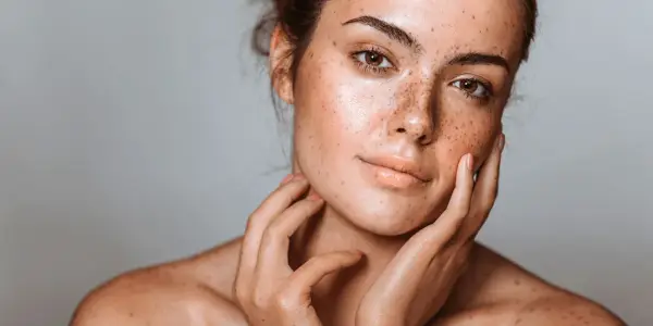 Visage d'une jeune femme aux taches brunes naturelles, ses mains caressant délicatement sa peau.