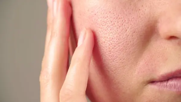 Gros plan sur une peau avec un pore dilaté visible, touchée par une main.