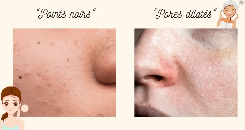 Gros plan sur la peau : points noirs d'un côté, et de l'autre, une zone avec des pores dilatés, suggérant un traitement.